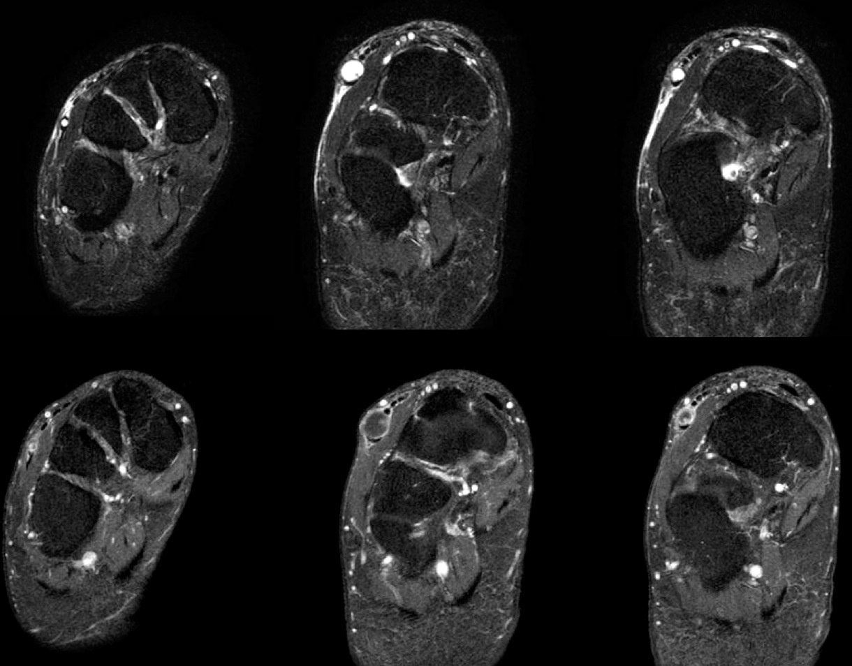 Figure 2 for case Intratendinous ganglion